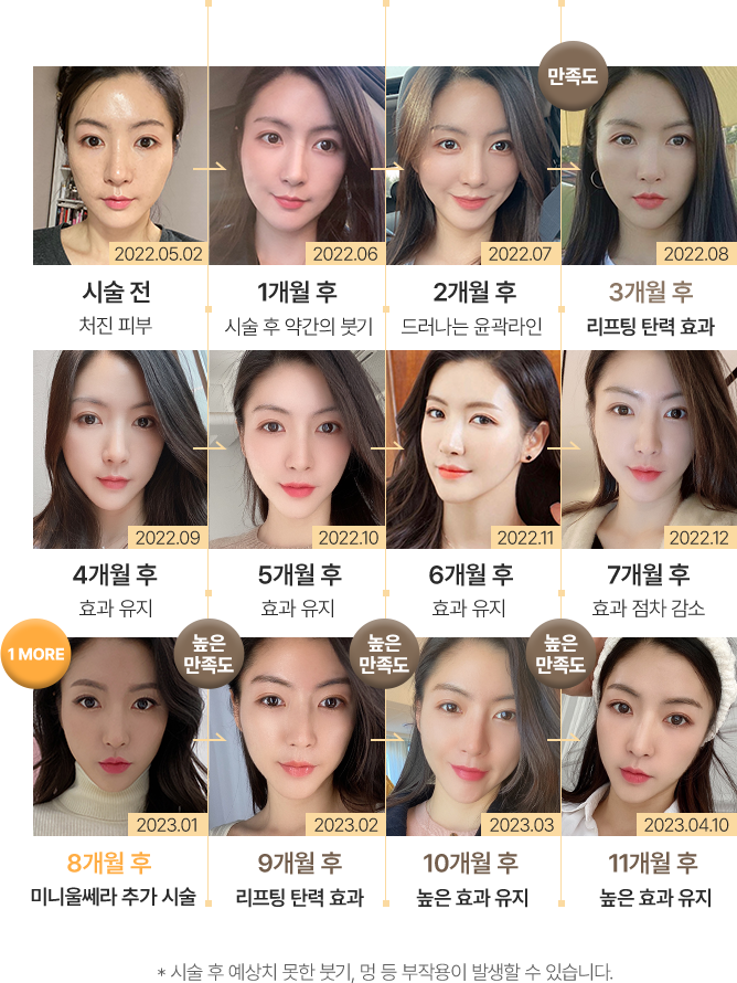스킨부스터,잘루프로,피부재생,피부보습,콜라겐부스터,울트라콜200,울트라콜,리쥬란힐러,마스크팩,리쥬란,피부비타민,리쥬란HB,리쥬란힐러가격,피부좋아지는법