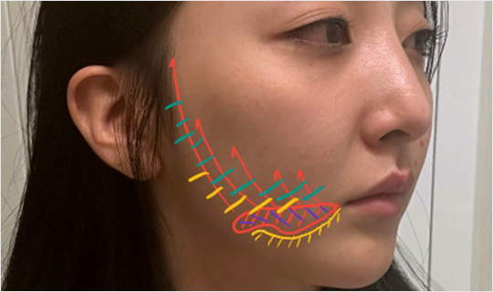 커스텀울쎄라,울쎄라부작용,울쎄라효과,울쎄라가격,울쎄라통증,울쎄라써마지,울쎄라전후,울쎄라인모드,가정용울쎄라,울쎄라슈링크,울쎄라올리지오