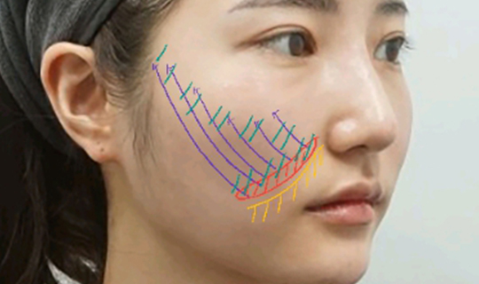 커스텀울쎄라,울쎄라부작용,울쎄라효과,울쎄라가격,울쎄라통증,울쎄라써마지,울쎄라전후,울쎄라인모드,가정용울쎄라,울쎄라슈링크,울쎄라올리지오