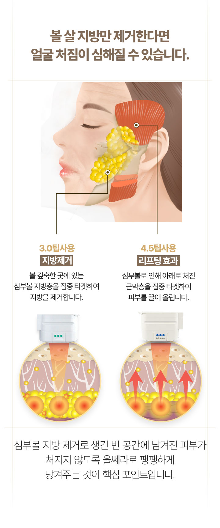 심부볼제거,심부볼위치,심부볼리프팅,심부볼인모드,심부볼윤곽주사,인모드심부볼,심부볼주사,이중턱,심술보,불독살제거,마리오네트주름,볼처짐,볼살지방흡입,불독살,심부볼지방제거비용,심부볼지방흡입,이중턱지방흡입,남자얼굴지방흡입,얼굴지방이식,턱지방흡입,얼굴지흡,볼살빼는법,이중턱살제거