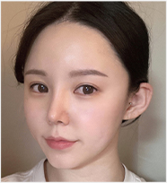 울쎄라전후,피부리프팅기기,얼굴리프팅,아이슈링크,슈링크리프팅,리프팅기구,홈케어슈링크,홈케어리프팅,인모드레이저,피부마사지기
