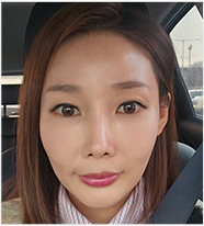 울쎄라전후,피부리프팅기기,얼굴리프팅,아이슈링크,슈링크리프팅,리프팅기구,홈케어슈링크,홈케어리프팅,인모드레이저,피부마사지기