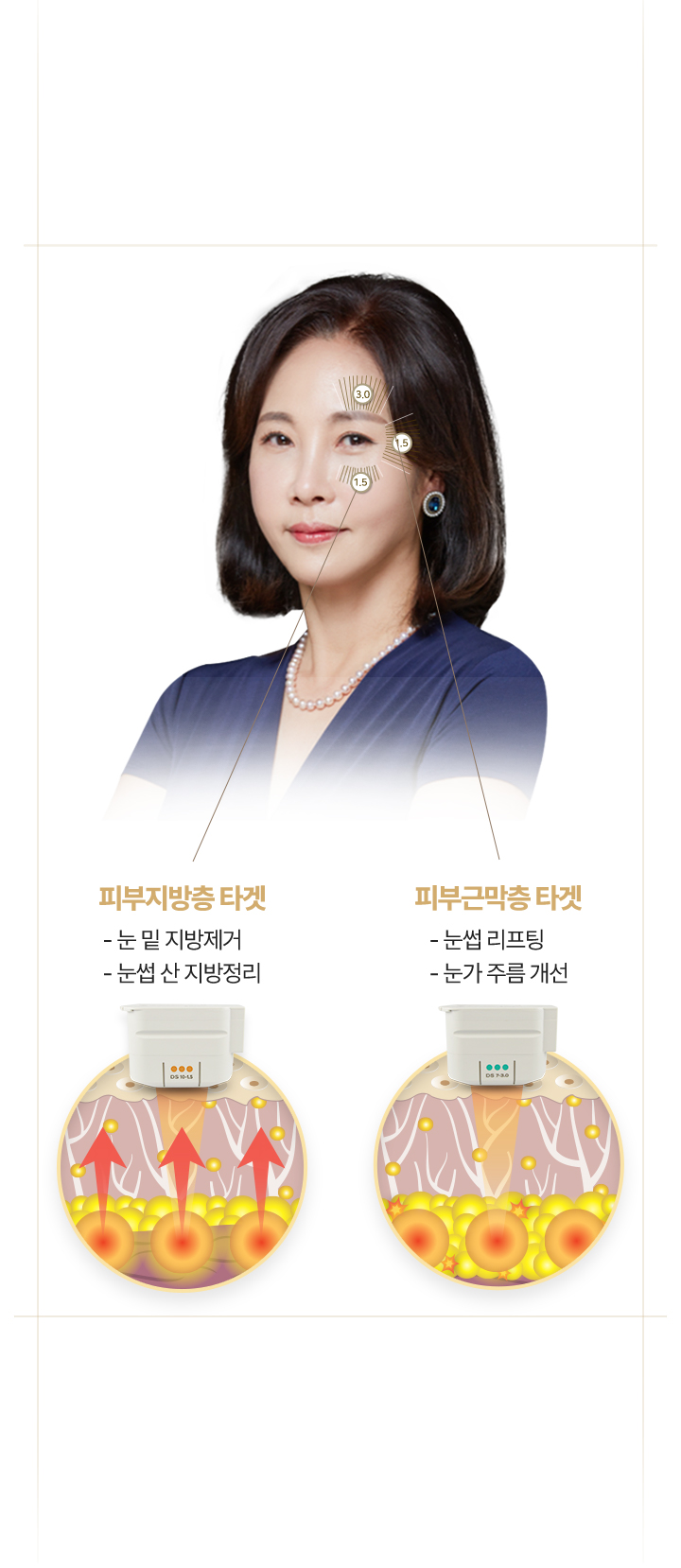 MJ울쎄라,아이울쎄라,초음파,초음파타겟팅,눈밑지방제거,눈썹리프팅,피부지방층,피부근막층,콜라겐재생,눈썹각도조정,눈섭리프팅
