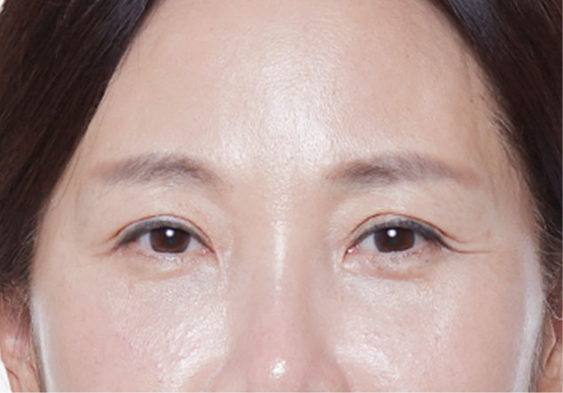 피부지방층,피부근막층,지방제거,리프팅,주름개선,지방제거,초음파,울쎄라,콜라겐재생,눈썹리프팅