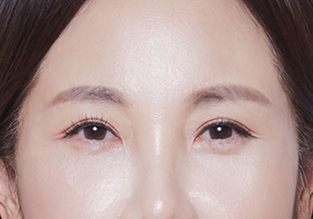 피부지방층,피부근막층,지방제거,리프팅,주름개선,지방제거,초음파,울쎄라,콜라겐재생,눈썹리프팅