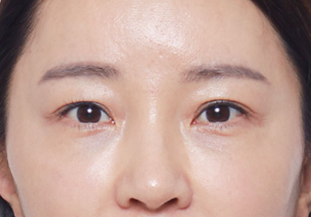 피부지방층,피부근막층,지방제거,리프팅,주름개선,지방제거,초음파,울쎄라,콜라겐재생,눈썹리프팅