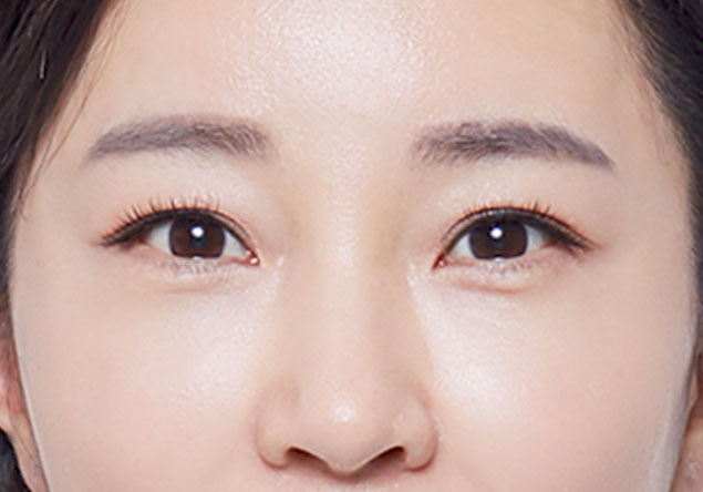 피부지방층,피부근막층,지방제거,리프팅,주름개선,지방제거,초음파,울쎄라,콜라겐재생,눈썹리프팅