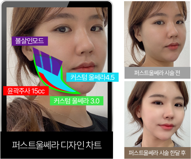 써마지정품팁,신사역울쎄라,울쎄라강남,서울울쎄라,얼굴리프팅잘하는곳,서울턱보톡스,하이푸리프팅,리프팅추천,울쎄라써마지가격,청담울쎄라