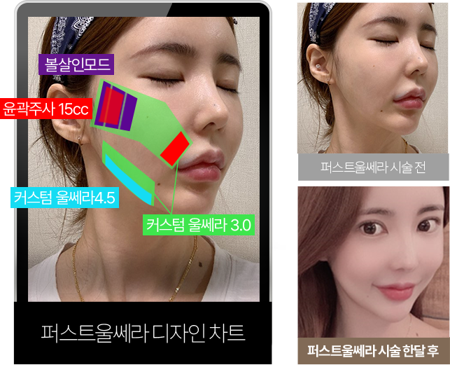 써마지정품팁,신사역울쎄라,울쎄라강남,서울울쎄라,얼굴리프팅잘하는곳,서울턱보톡스,하이푸리프팅,리프팅추천,울쎄라써마지가격,청담울쎄라