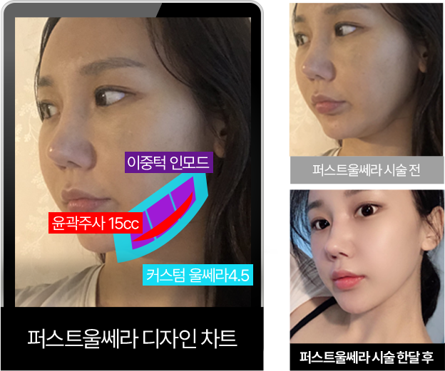 써마지정품팁,신사역울쎄라,울쎄라강남,서울울쎄라,얼굴리프팅잘하는곳,서울턱보톡스,하이푸리프팅,리프팅추천,울쎄라써마지가격,청담울쎄라