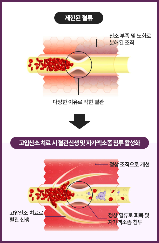 IBEX,고압산소,산소챔버,고압옥시젠 파워 스템셀기가격,옥시젠 파워 스템셀기,고압산소캡슐,산소방