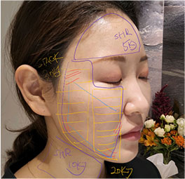포르테티타늄
