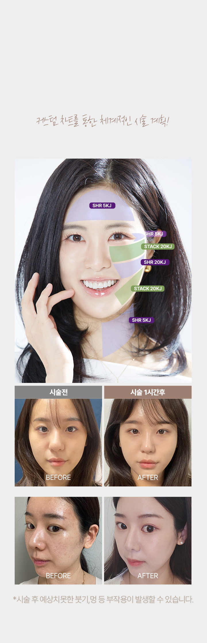 청담리프팅,처진볼살리프팅,피부리프팅,광대주사,실리프팅가격,턱살빼는법,팔자주름귀족침,얼굴실리프팅가격,팔자리프팅,페이스리프팅,남자리프팅,얼굴팔자주름,레이저리프팅,얼굴처짐,안면리프팅