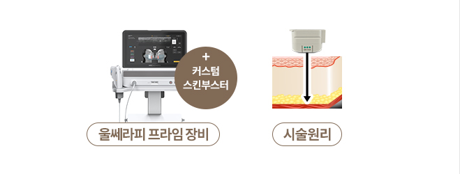 울쎄라멍,울쎄라 효과시기,울쎄라,슈링크효과,인모드효과,울쎄라후기,울쎄라리프팅,울써마지,써마지,아이울쎄라,커스텀울쎄라,커스텀써마지 