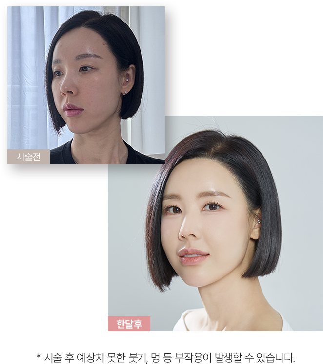 필러녹이기,필러,입술필러