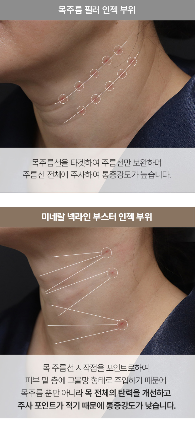 필러녹이기,필러,눈밑필러