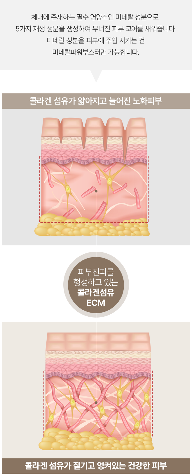 필러녹이기,필러,눈밑필러