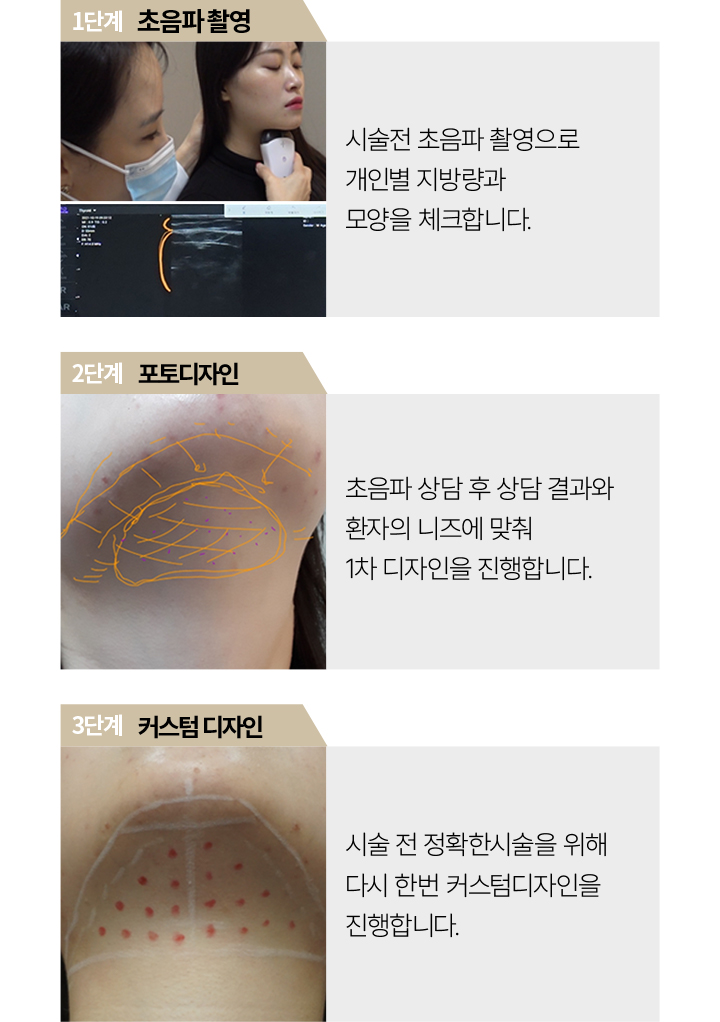 포텐자모공,스컬트라필러,안티에이징,워터핏,베네브,강남구청역성형외과,셀라스프락셀,쥬베룩결절,쥬베룩리쥬란,쥬베룩모공,물광주사,포텐자피부과,튼살치료,튼살