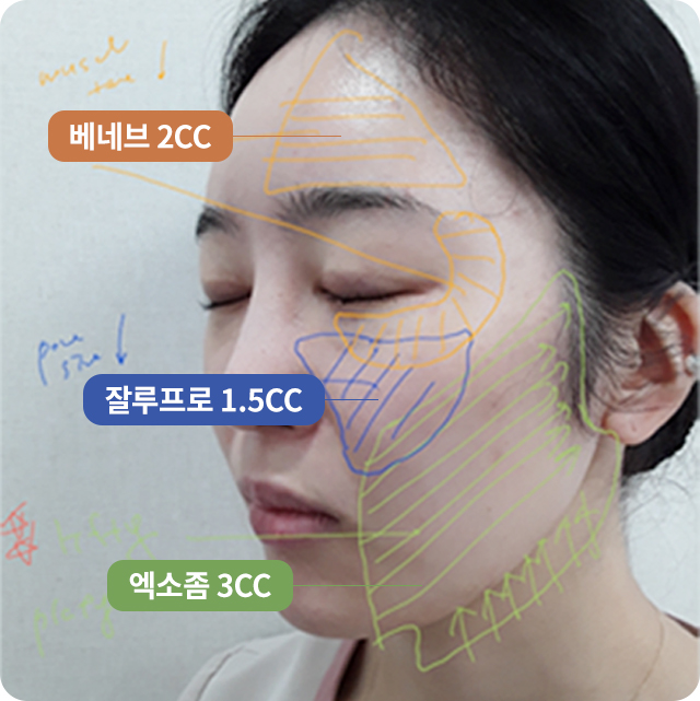 리쥬란아이가격,리쥬란샤인,리쥬란힐러피부과,리쥬란힐러추천,리쥬란힐러HB,리쥬란힐러비용,아이리쥬란,엑소좀스킨부스터,아이리쥬란힐러