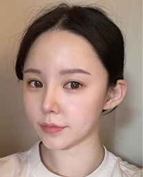 울쎄라전후,피부리프팅기기,얼굴리프팅,아이슈링크,슈링크리프팅,리프팅기구,홈케어슈링크,홈케어리프팅,인모드레이저,피부마사지기