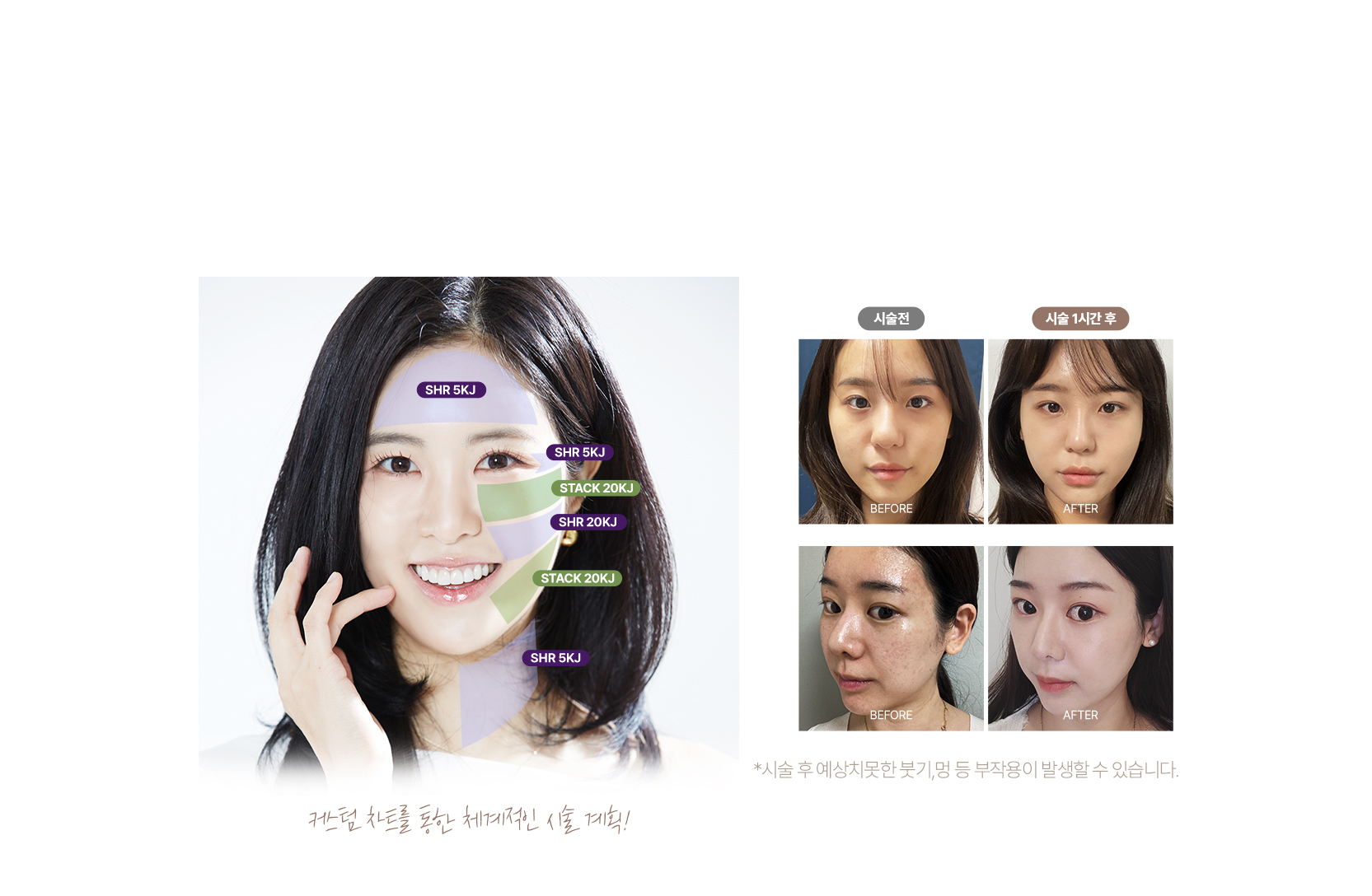 청담리프팅,처진볼살리프팅,피부리프팅,광대주사,실리프팅가격,턱살빼는법,팔자주름귀족침,얼굴실리프팅가격,팔자리프팅,페이스리프팅,남자리프팅,얼굴팔자주름,레이저리프팅,얼굴처짐,안면리프팅