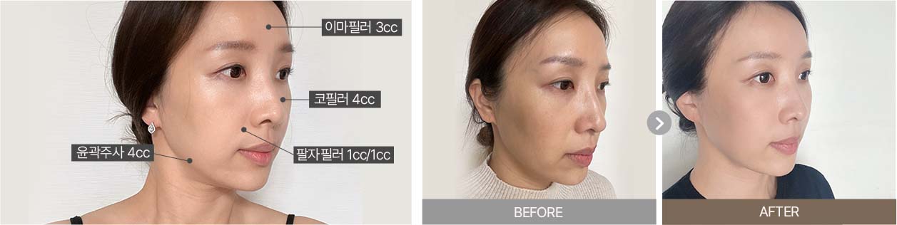 울쎄라전후,피부리프팅기기,얼굴리프팅,아이슈링크,슈링크리프팅,리프팅기구,홈케어슈링크,홈케어리프팅,인모드레이저,피부마사지기