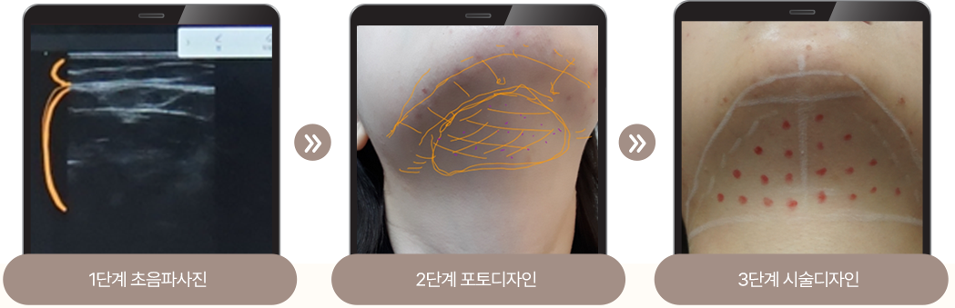 윤곽보톡스,사각턱주사,동안침,윤곽약침,매선,정안침,매선침,비만주사,이중턱살제거,불독살,팔자주름,얼굴리프팅,팔자주름없애기,윤곽주사전후,얼굴살빼는법,매선치료,실리프팅,지방이식,리프팅,팔자주름시술,심부볼제거,심부볼지방제거,얼굴실리프팅,한방코성형,턱살보톡스,얼굴살주사,볼살제거,볼살시술